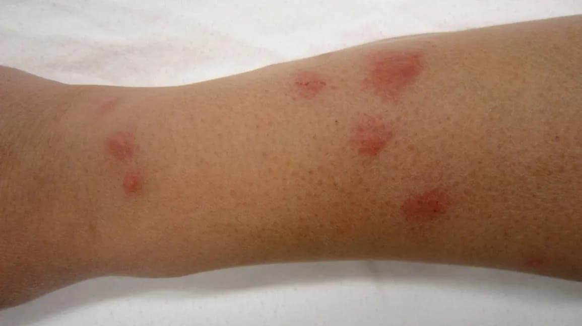 Bed bug bite marks on human skin showing linear pattern